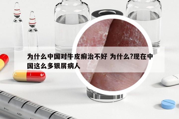 為什么中國對牛皮癬治不好 為什么?現(xiàn)在中國這么多銀屑病人