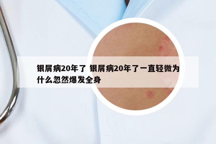 銀屑病20年了 銀屑病20年了一直輕微為什么忽然爆發(fā)全身