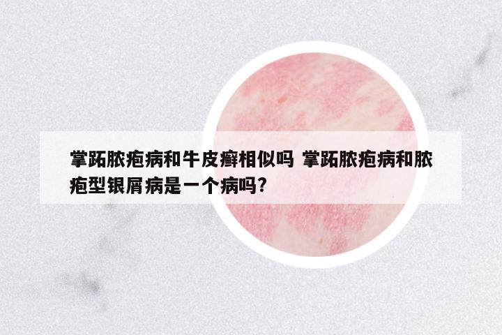 掌跖膿皰病和牛皮癬相似嗎 掌跖膿皰病和膿皰型銀屑病是一個病嗎?
