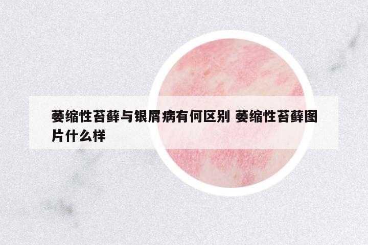 萎縮性苔蘚與銀屑病有何區(qū)別 萎縮性苔蘚圖片什么樣