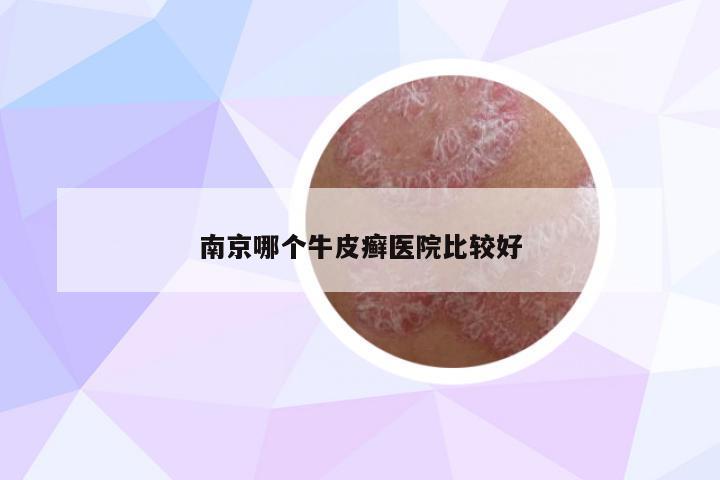 南京哪個(gè)牛皮癬醫(yī)院比較好