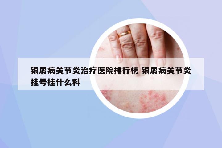 銀屑病關(guān)節(jié)炎治療醫(yī)院排行榜 銀屑病關(guān)節(jié)炎掛號掛什么科