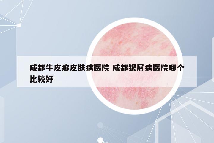 成都牛皮癬皮膚病醫(yī)院 成都銀屑病醫(yī)院哪個比較好
