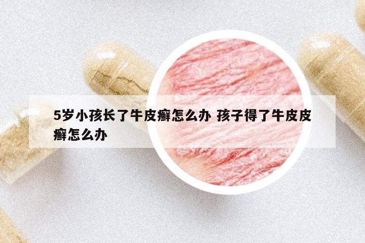 5歲小孩長了牛皮癬怎么辦 孩子得了牛皮皮癬怎么辦