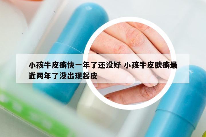 小孩牛皮癬快一年了還沒好 小孩牛皮膚癬最近兩年了沒出現(xiàn)起皮
