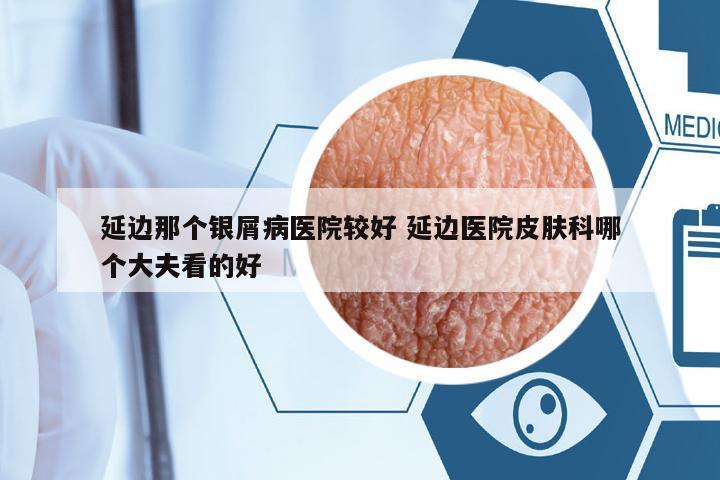 延邊那個銀屑病醫(yī)院較好 延邊醫(yī)院皮膚科哪個大夫看的好