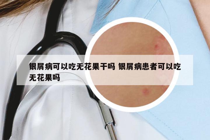 銀屑病可以吃無花果干嗎 銀屑病患者可以吃無花果嗎