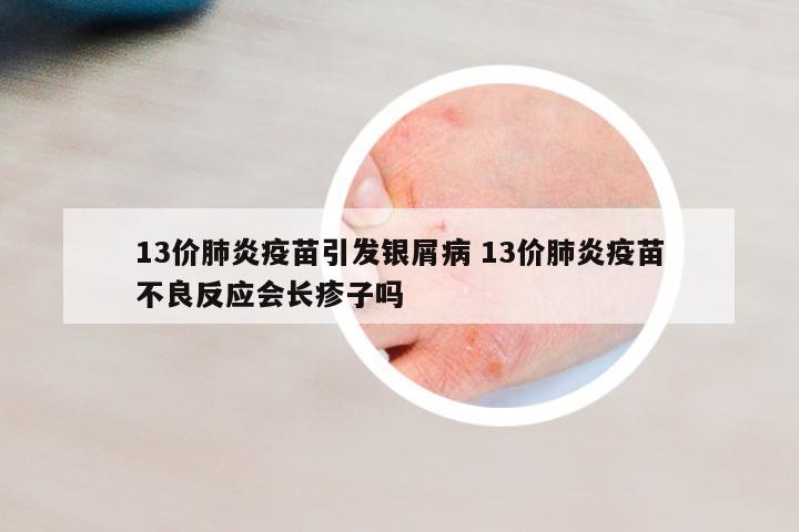 13價肺炎疫苗引發(fā)銀屑病 13價肺炎疫苗不良反應(yīng)會長疹子嗎