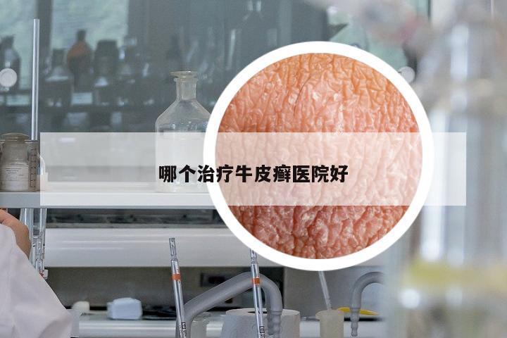 哪個治療牛皮癬醫(yī)院好