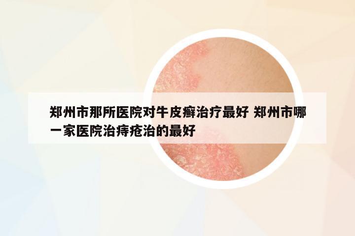 鄭州市那所醫(yī)院對牛皮癬治療最好 鄭州市哪一家醫(yī)院治痔瘡治的最好