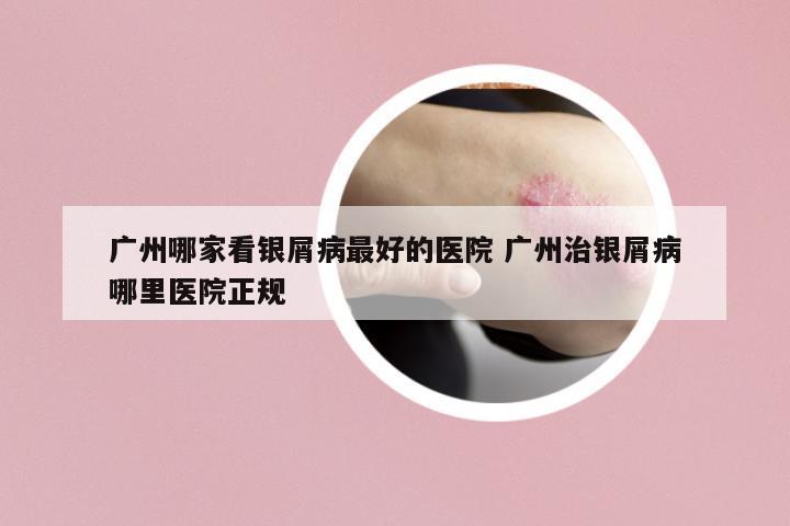 廣州哪家看銀屑病最好的醫(yī)院 廣州治銀屑病哪里醫(yī)院正規(guī)