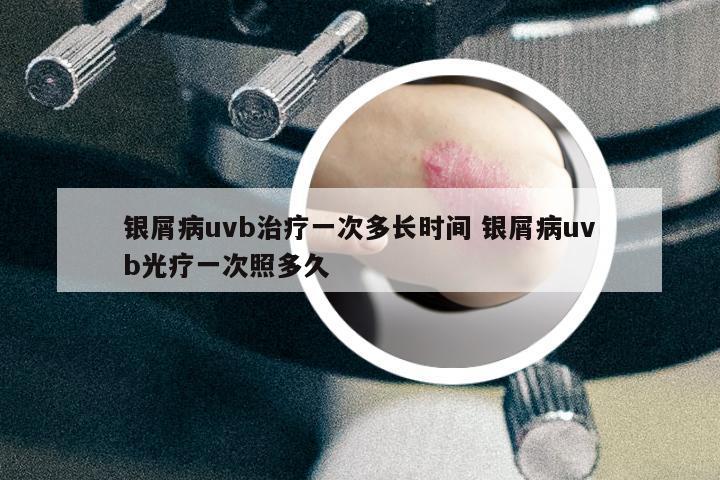 銀屑病uvb治療一次多長(zhǎng)時(shí)間 銀屑病uvb光療一次照多久