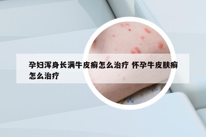 孕婦渾身長滿牛皮癬怎么治療 懷孕牛皮膚癬怎么治療