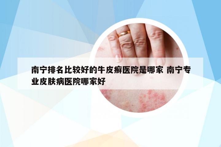 南寧排名比較好的牛皮癬醫(yī)院是哪家 南寧專業(yè)皮膚病醫(yī)院哪家好
