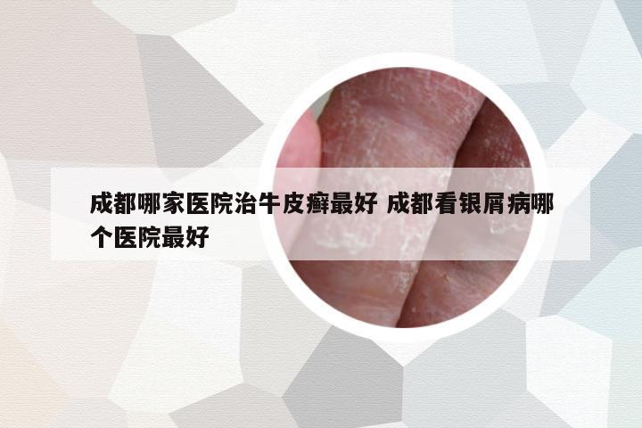 成都哪家醫(yī)院治牛皮癬最好 成都看銀屑病哪個(gè)醫(yī)院最好