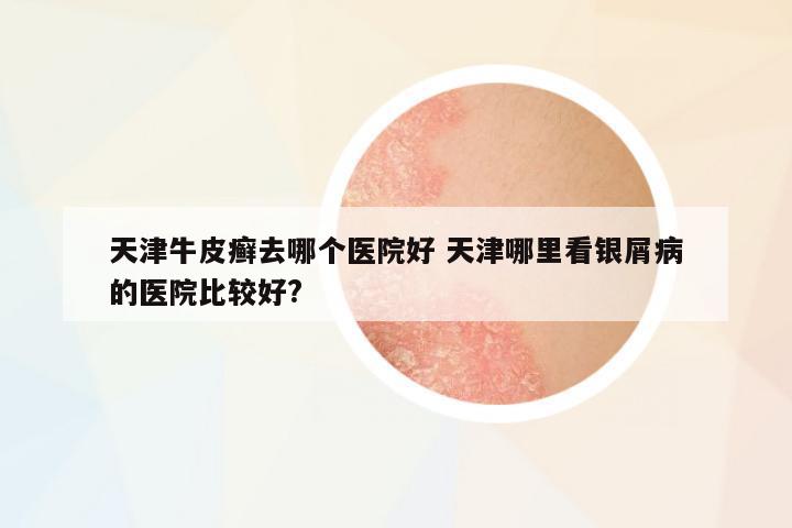 天津牛皮癬去哪個醫(yī)院好 天津哪里看銀屑病的醫(yī)院比較好?