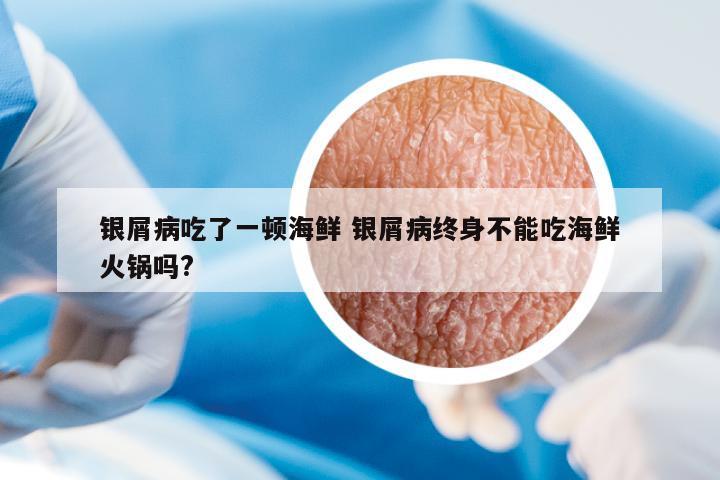銀屑病吃了一頓海鮮 銀屑病終身不能吃海鮮火鍋嗎?