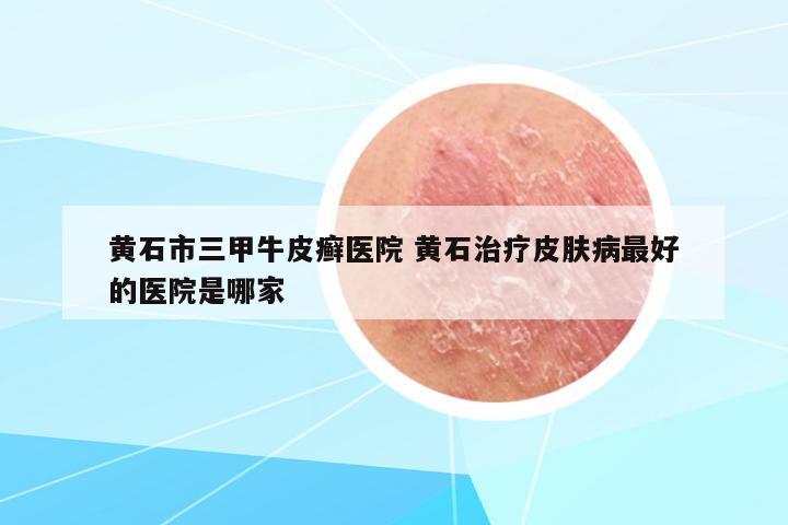黃石市三甲牛皮癬醫(yī)院 黃石治療皮膚病最好的醫(yī)院是哪家