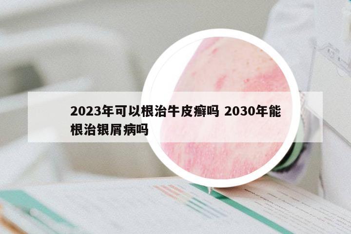 2023年可以根治牛皮癬嗎 2030年能根治銀屑病嗎