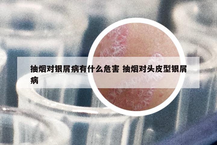 抽煙對(duì)銀屑病有什么危害 抽煙對(duì)頭皮型銀屑病