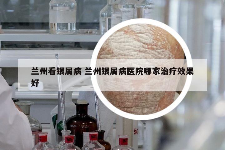 蘭州看銀屑病 蘭州銀屑病醫(yī)院哪家治療效果好