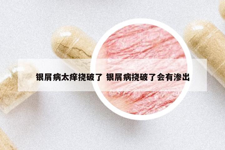 銀屑病太癢撓破了 銀屑病撓破了會有滲出