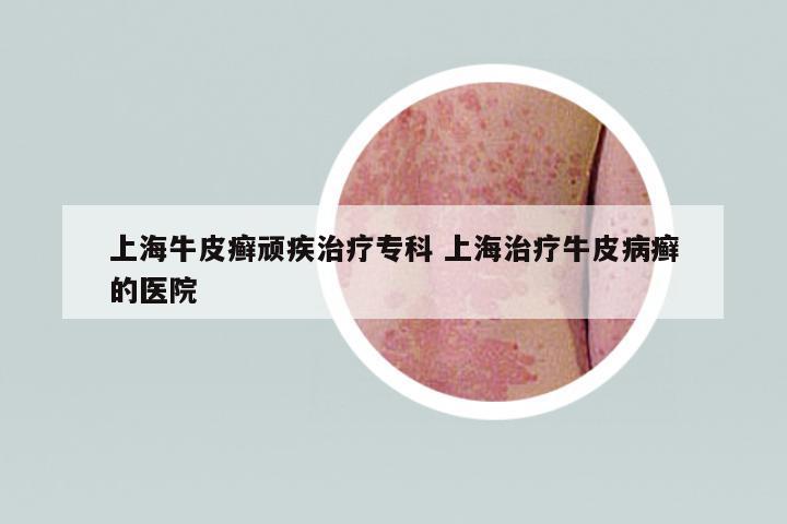 上海牛皮癬頑疾治療專科 上海治療牛皮病癬的醫(yī)院