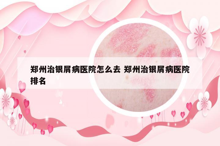 鄭州治銀屑病醫(yī)院怎么去 鄭州治銀屑病醫(yī)院排名