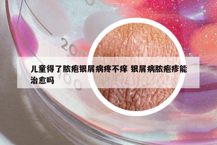 兒童得了膿皰銀屑病疼不癢 銀屑病膿皰疹能治愈嗎