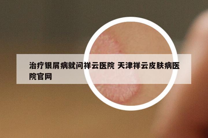治療銀屑病就問祥云醫(yī)院 天津祥云皮膚病醫(yī)院官網(wǎng)