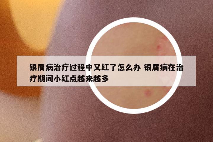 銀屑病治療過程中又紅了怎么辦 銀屑病在治療期間小紅點(diǎn)越來越多