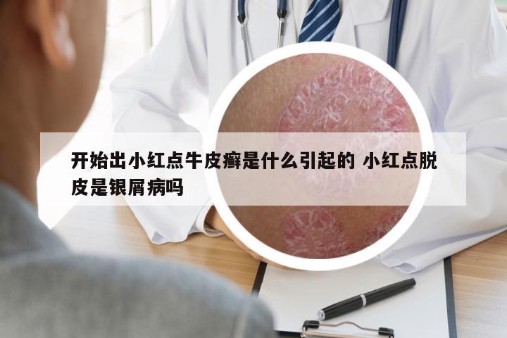 開始出小紅點(diǎn)牛皮癬是什么引起的 小紅點(diǎn)脫皮是銀屑病嗎