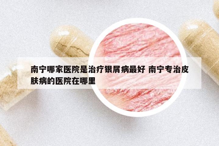 南寧哪家醫(yī)院是治療銀屑病最好 南寧專治皮膚病的醫(yī)院在哪里