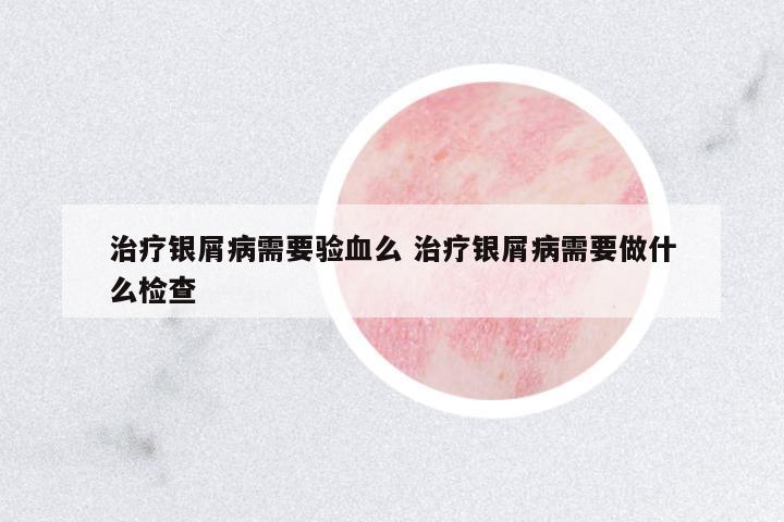 治療銀屑病需要驗血么 治療銀屑病需要做什么檢查