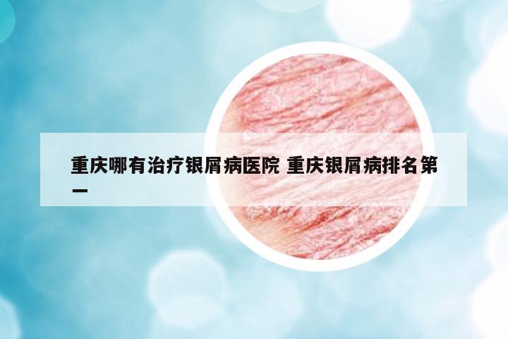 重慶哪有治療銀屑病醫(yī)院 重慶銀屑病排名第一