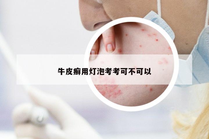 牛皮癬用燈泡考考可不可以
