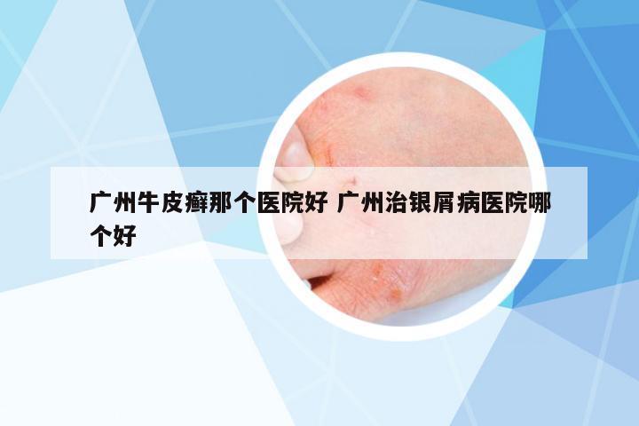 廣州牛皮癬那個醫(yī)院好 廣州治銀屑病醫(yī)院哪個好