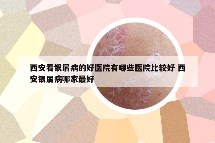 西安看銀屑病的好醫(yī)院有哪些醫(yī)院比較好 西安銀屑病哪家最好