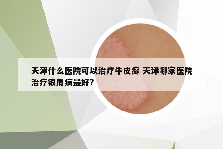 天津什么醫(yī)院可以治療牛皮癬 天津哪家醫(yī)院治療銀屑病最好?