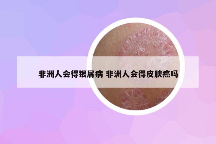 非洲人會得銀屑病 非洲人會得皮膚癌嗎