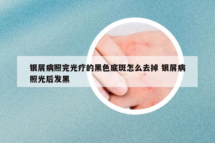 銀屑病照完光療的黑色底斑怎么去掉 銀屑病照光后發(fā)黑