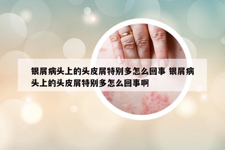 銀屑病頭上的頭皮屑特別多怎么回事 銀屑病頭上的頭皮屑特別多怎么回事啊
