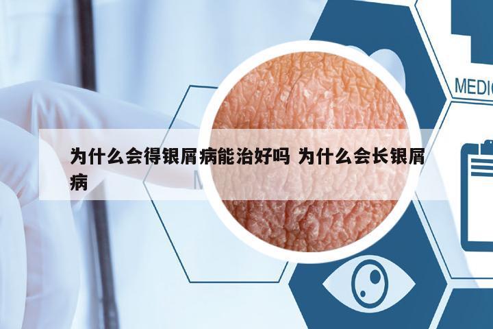 為什么會(huì)得銀屑病能治好嗎 為什么會(huì)長(zhǎng)銀屑病