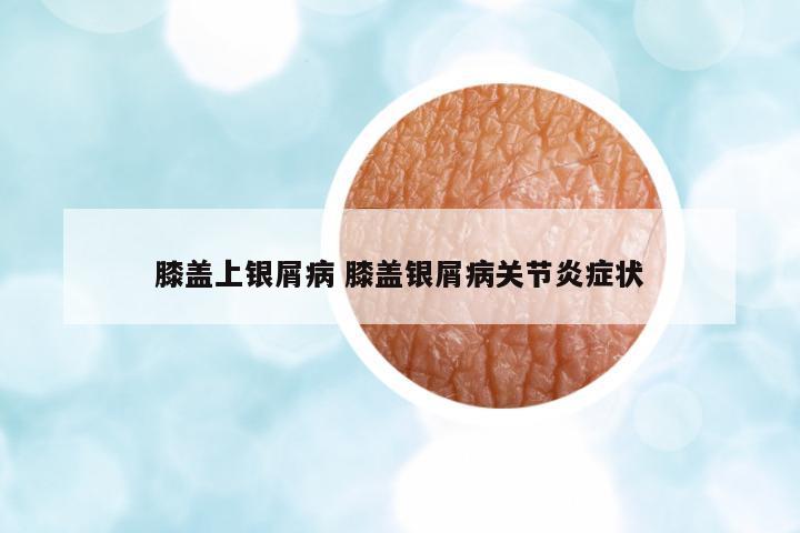 膝蓋上銀屑病 膝蓋銀屑病關節(jié)炎癥狀