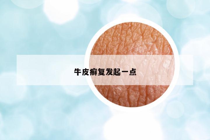 牛皮癬復(fù)發(fā)起一點(diǎn)