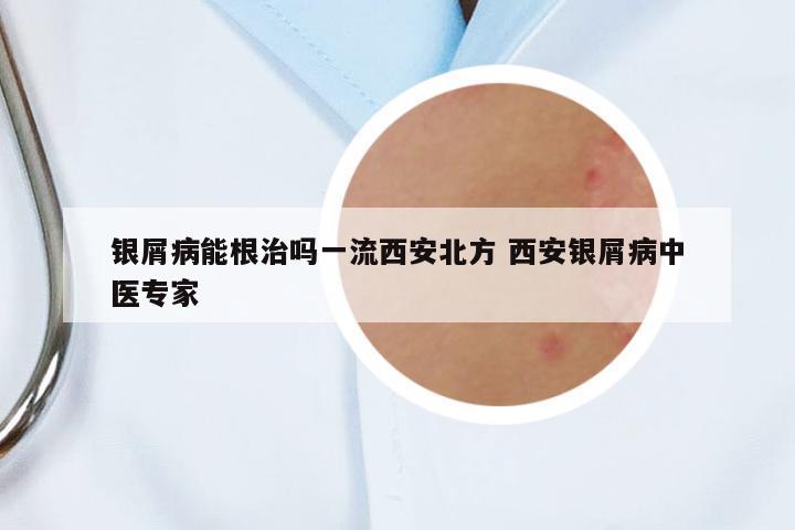 銀屑病能根治嗎一流西安北方 西安銀屑病中醫(yī)專家