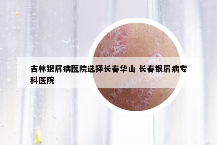 吉林銀屑病醫(yī)院選擇長(zhǎng)春華山 長(zhǎng)春銀屑病??漆t(yī)院