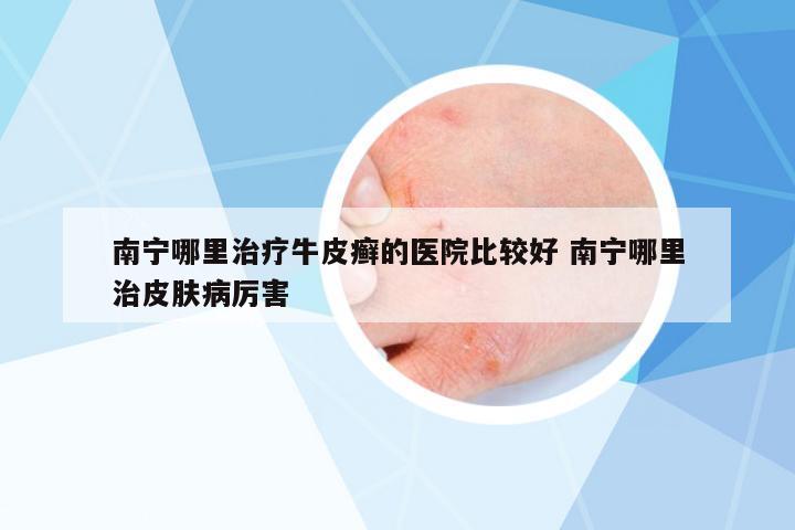 南寧哪里治療牛皮癬的醫(yī)院比較好 南寧哪里治皮膚病厲害