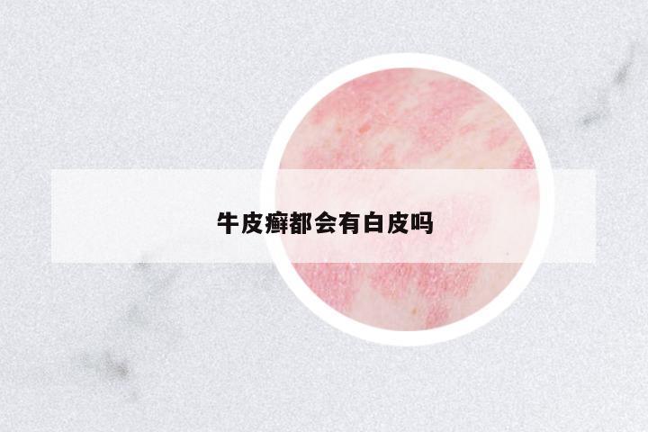 牛皮癬都會(huì)有白皮嗎
