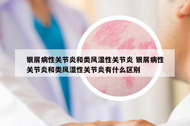銀屑病性關(guān)節(jié)炎和類風(fēng)濕性關(guān)節(jié)炎 銀屑病性關(guān)節(jié)炎和類風(fēng)濕性關(guān)節(jié)炎有什么區(qū)別